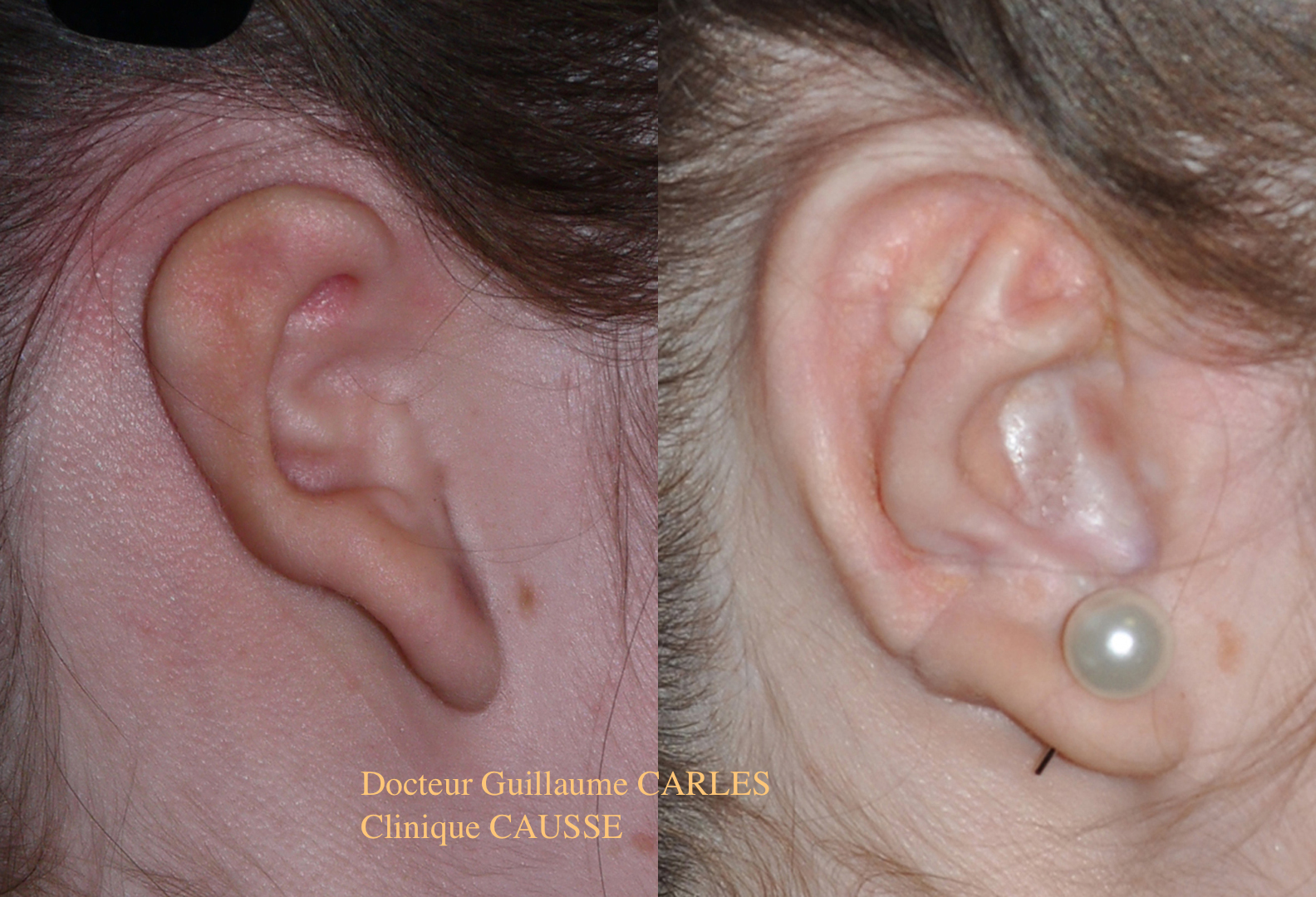Chirurgie Reparatrice Oreilles Malformation Et Aplasie Oreilles Microtie