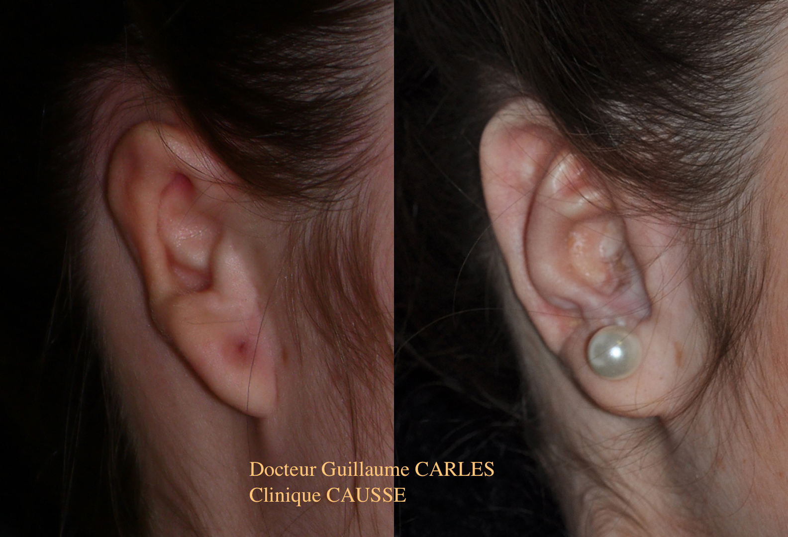 Chirurgie Reparatrice Oreilles Malformation Et Aplasie Oreilles Microtie