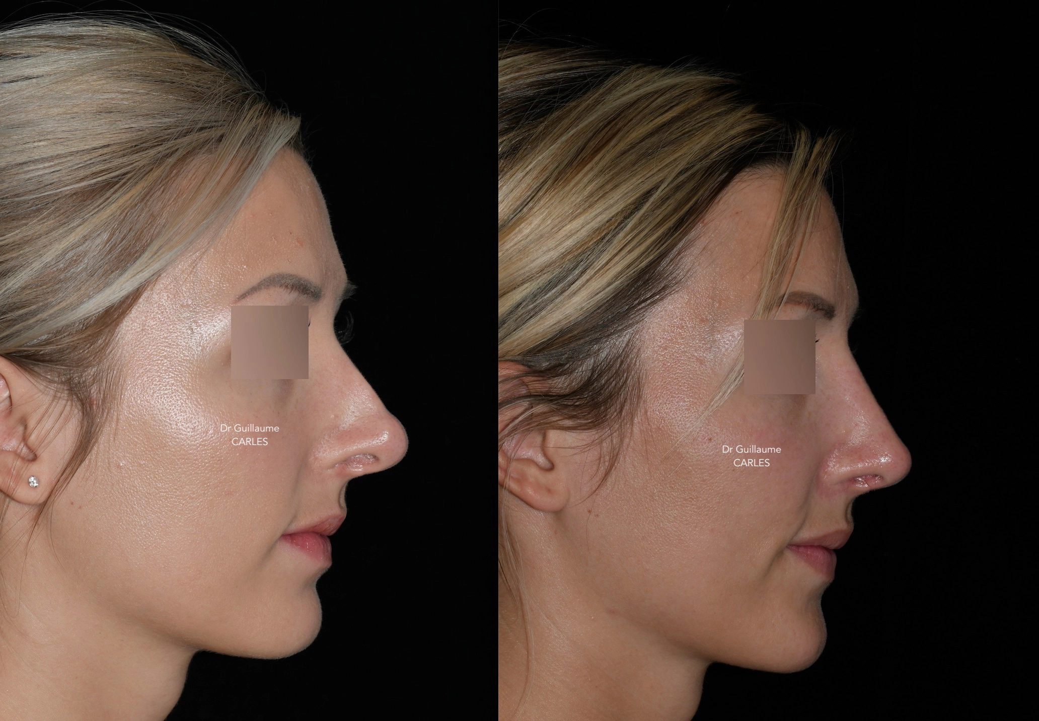 Les résultats avant/après de rhinoplastie secondaire - présentation de ...